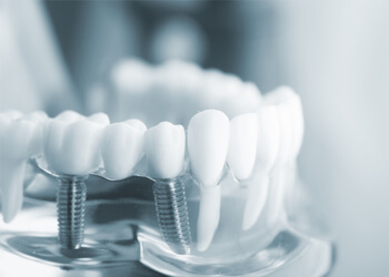 dental implants dental treatment 21st century richmond tlc dentists